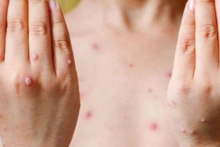Most local monkeypox cases have infectious syndrome caused by HIV