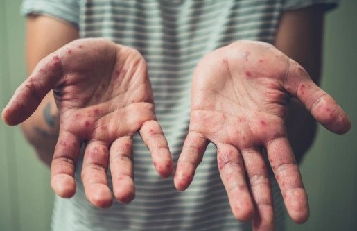 vietnam s sixth monkeypox case detected in ho chi minh city picture 1