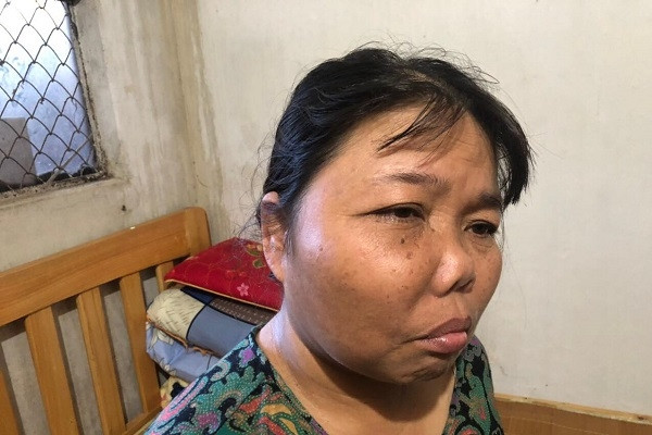 Bị u xương hàm biến dạng mặt, người phụ nữ cầm cự