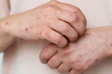 HCM City records four more monkeypox cases