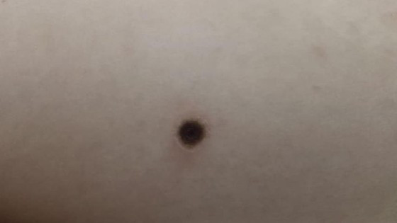 Enlarged lymph nodes on the baby girl ảnh 1