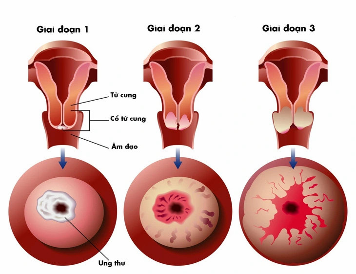 1 hinh anh khoi u thu co tu cung.jpg