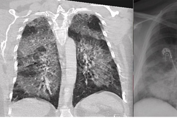 Hình ảnh phổi bị thuốc lá điện tử tàn phá nghiêm trọng
