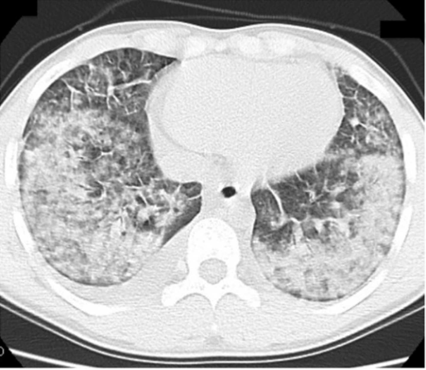 thuốc lá điện tử who 2.jpg