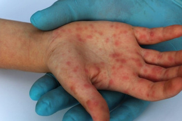 56 monkeypox cases recorded in Vietnam