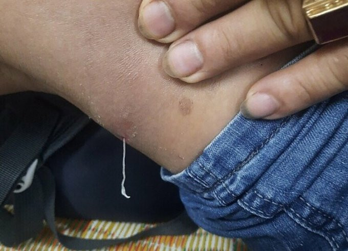 Người đàn ông kéo ra sinh vật lạ dưới da khi gãi ngứa