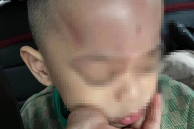 Phụ huynh tố cô giáo bạo hành trẻ, công an kết luận ra sao?