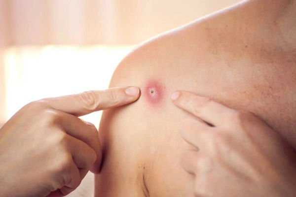Công văn khẩn về việc tăng cường phòng chống bệnh đậu mùa khỉ