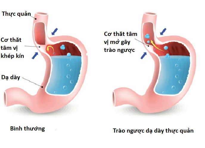 Nguy cơ ung thư thực quản từ chứng trào ngược dạ dày thực quản