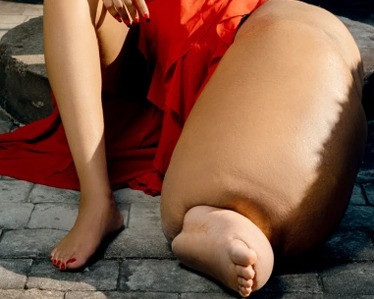 Bệnh lạ khiến cô gái xinh đẹp có một chân nặng 45kg