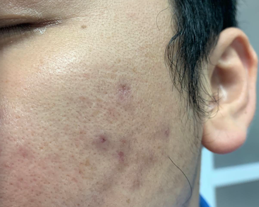 Nam thanh niên ở Hà Nội có hàng chục nốt sẩn trên má sau tiêm meso căng sáng da
