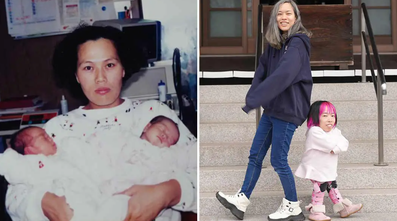 Chị em sinh đôi lệch nhau gần 1m lập kỷ lục thế giới