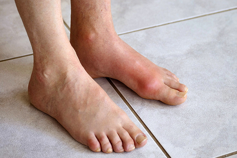 7 quan niệm sai lầm về bệnh gout