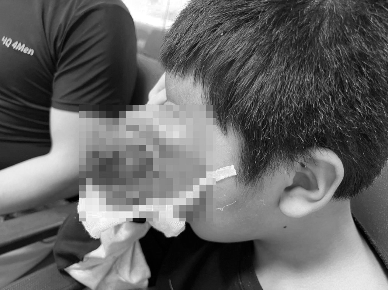 Nhiều nơi từ chối mổ, bé trai đau đớn vì khối u khổng lồ ở mắt
