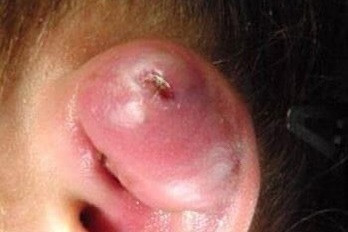 Bấm khuyên ở vành tai, cô gái 18 tuổi gặp di chứng nặng