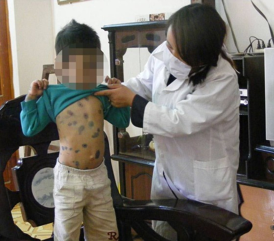 Chickenpox cases soaring in Hanoi, mostly in children ảnh 1