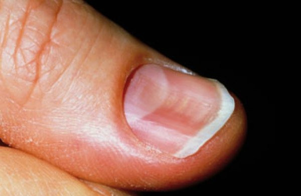 Móng tay biến dạng cảnh báo nhiều loại bệnh