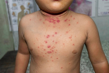 Experts warns of potential chickenpox outbreak in Hanoi