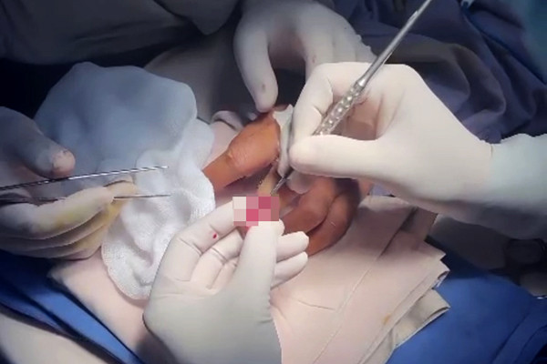 Phát hiện khối u hiếm gặp dưới móng tay sau 5 năm chịu đau