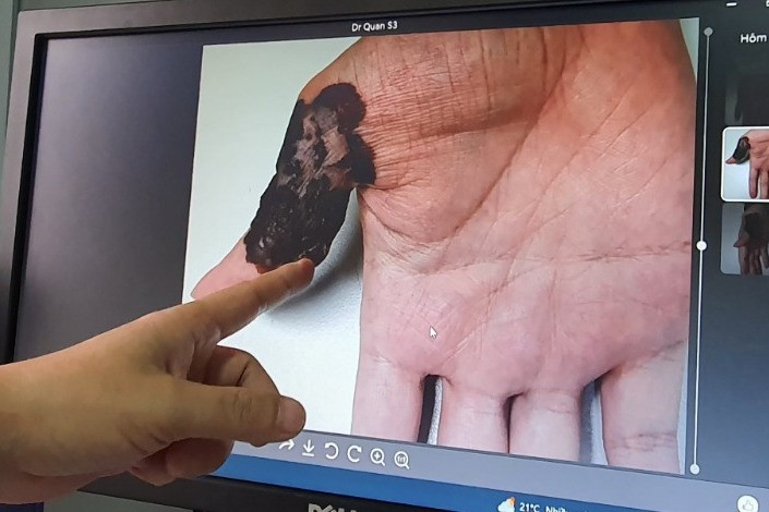 Nam thanh niên Hà Nội phát hiện ung thư da từ nốt ruồi trên bàn tay