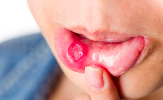 Dấu hiệu sớm cảnh báo ung thư lưỡi nhưng thường dễ nhầm lẫn