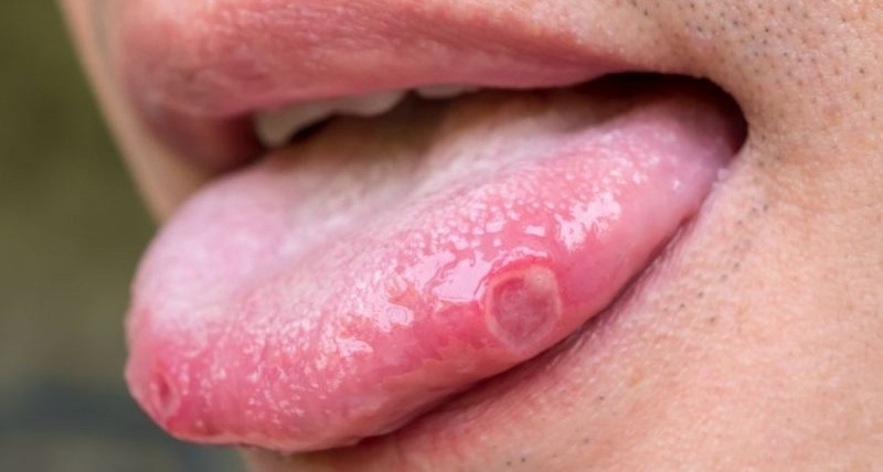 Liên quan của virus HPV đến hiện tượng ung thư lưỡi là gì?
