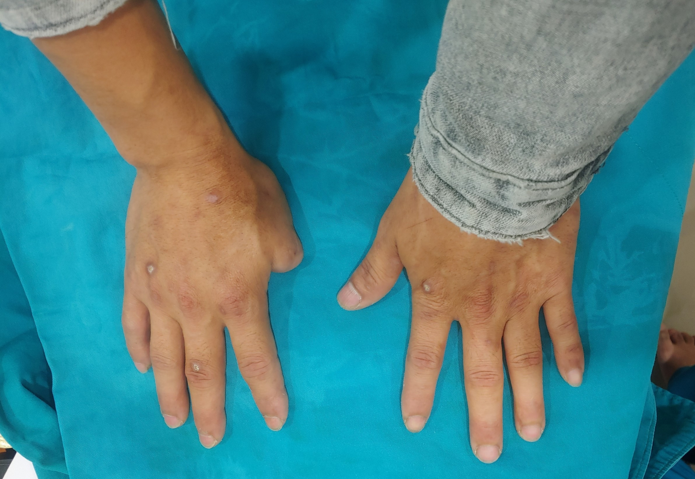 Người đàn ông được ghép ngón tay từ ngón chân sau 10 năm bị tai nạn