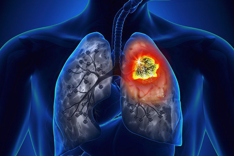 3 dấu hiệu điển hình của ung thư phổi