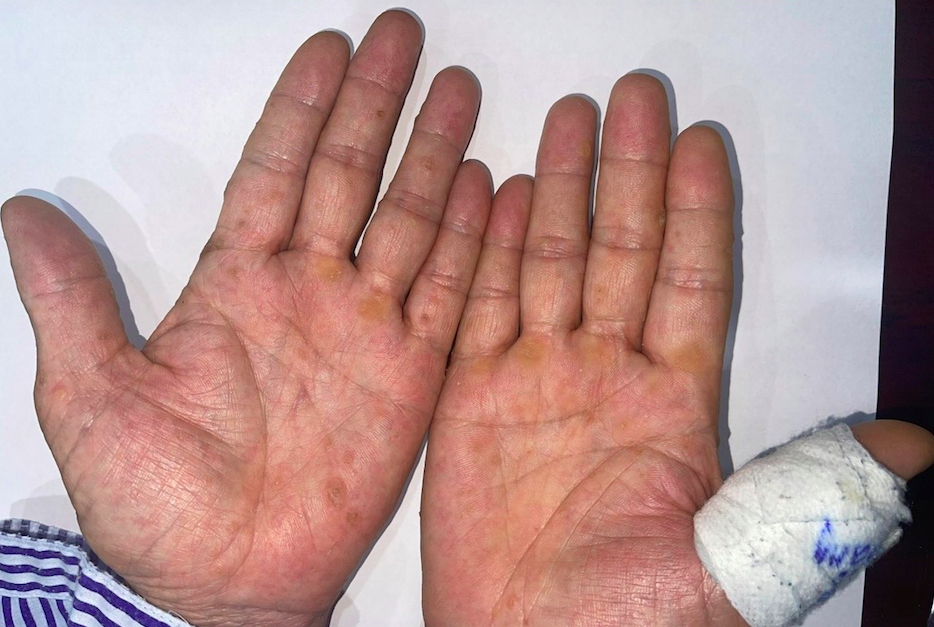 Phát hiện ung thư từ dấu hiệu lạ ở bàn tay