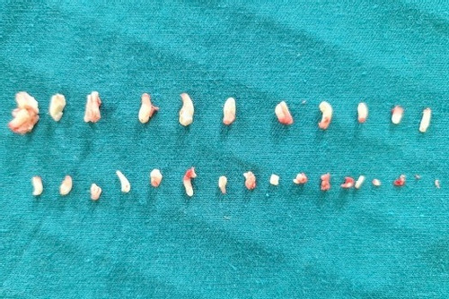 Tìm thấy 28 chiếc răng nằm trong khối u