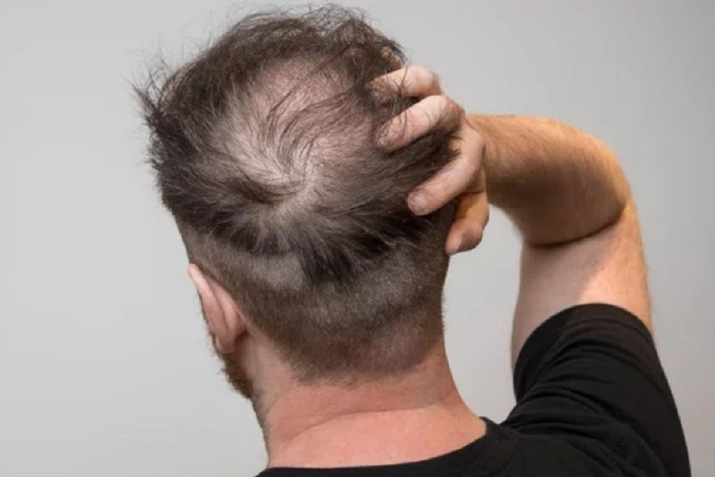 Đi khám vì tóc rụng, người đàn ông bất ngờ phát hiện mắc giang mai