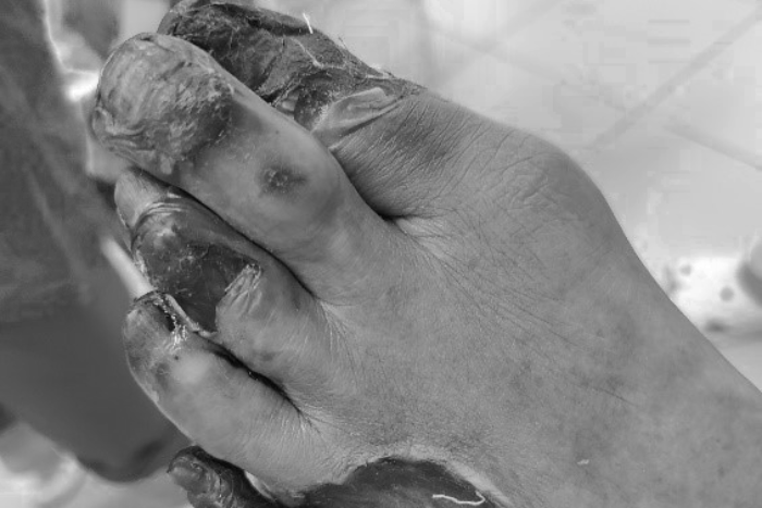 Chi dưới khô đen vì đắp lá chữa tê chân