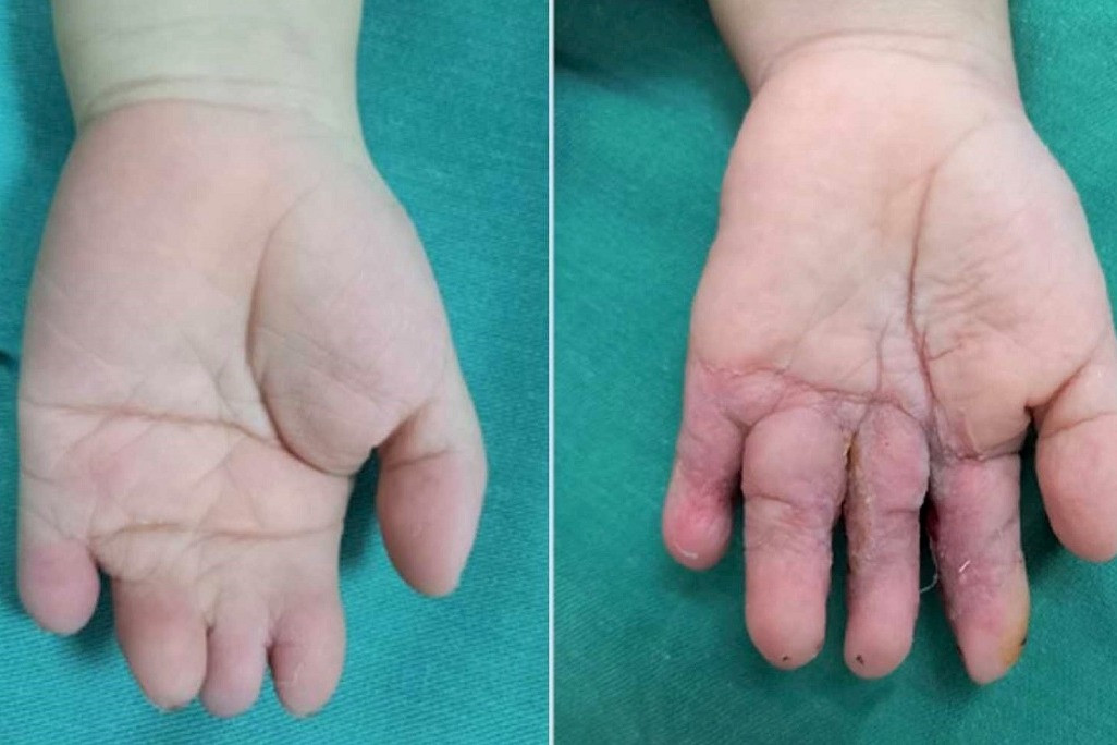 Em bé chào đời với bàn tay bị dính liền 4 ngón
