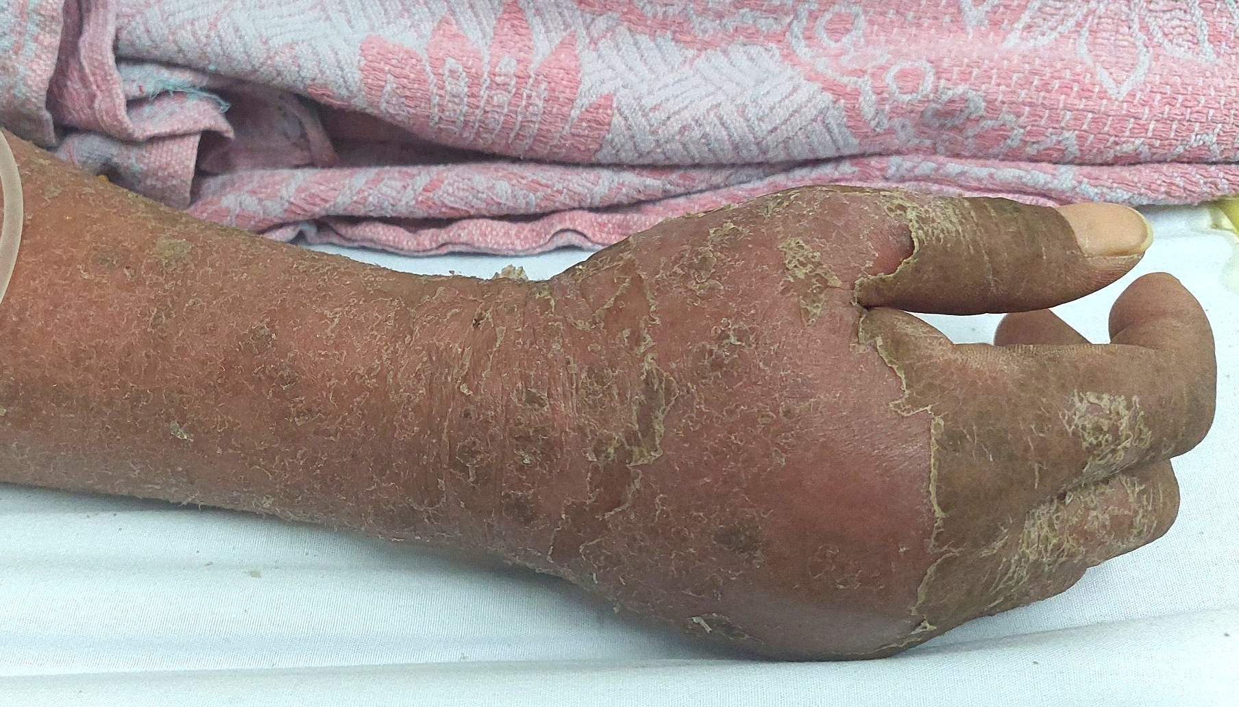 Hình ảnh bàn tay của bệnh nhân điều trị lao hạch dị ứng thuốc ...