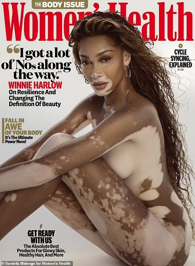 Người mẫu Winnie Harlow khỏa thân khoe làn da bạch biến - 1