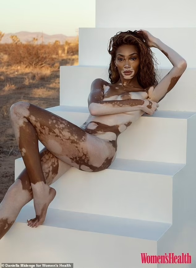 Người mẫu Winnie Harlow khỏa thân khoe làn da bạch biến - 2