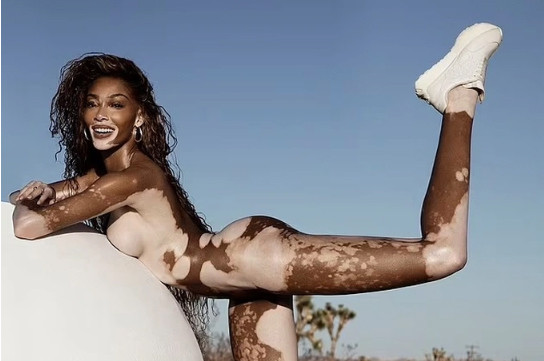 Người mẫu Winnie Harlow khỏa thân khoe làn da bạch biến