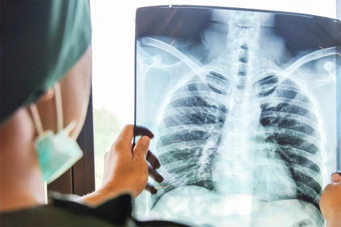 Sụt 4 kg, khó thở, đi khám phát hiện ung thư giai đoạn cuối