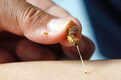 Kỳ lạ cách thầy lang chữa bệnh: Cho ong đốt khắp người