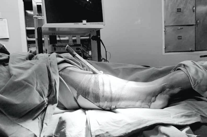 Đến viện cấp cứu lúc nửa đêm với thanh sắt dài đâm xuyên đùi