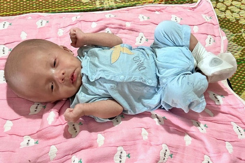 Sự sống mong manh của bé trai 2 tháng tuổi bị não úng thủy và dị tật hậu môn