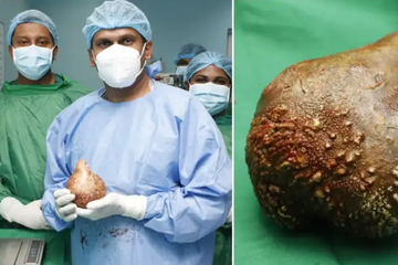 Phẫu thuật loại bỏ viên sỏi thận lớn nhất, nặng nhất thế giới ở Sri Lanka