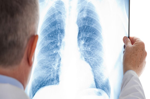 Vào viện để mổ ruột thừa, bác sĩ phát hiện thêm bệnh nguy hiểm ở phổi