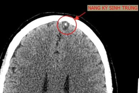 Não bị tàn phá nghi do món ăn phổ biến ở Việt Nam