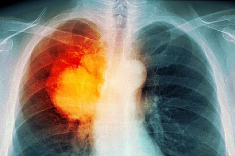 Ung thư phổi di căn gan nghi do thói quen gần 50% đàn ông Việt mắc phải