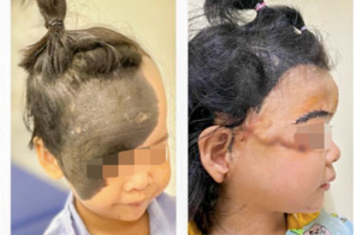 Căn bệnh rất hiếm gặp khiến cô bé có làn 'da trâu' phủ nửa mặt