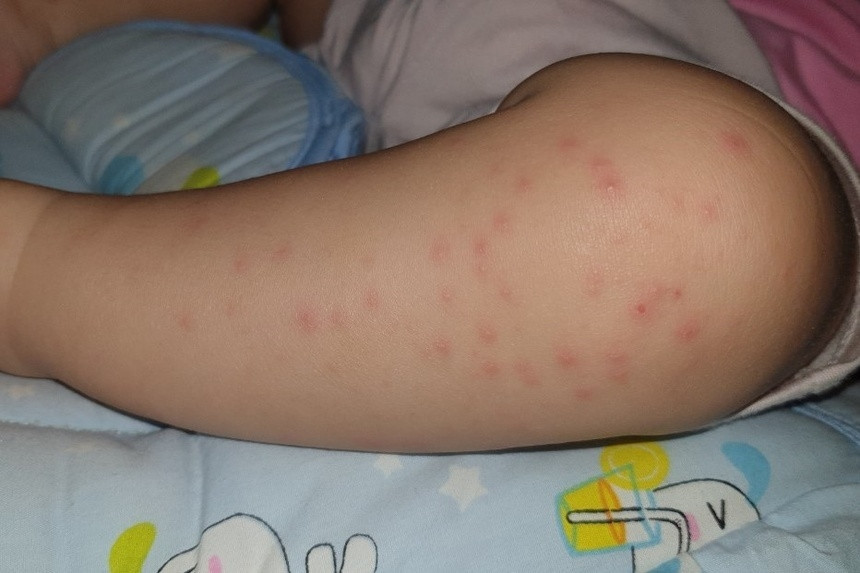 Virus gây bệnh tay chân miệng Enterovirus 71 độc nhất nguy hiểm ...