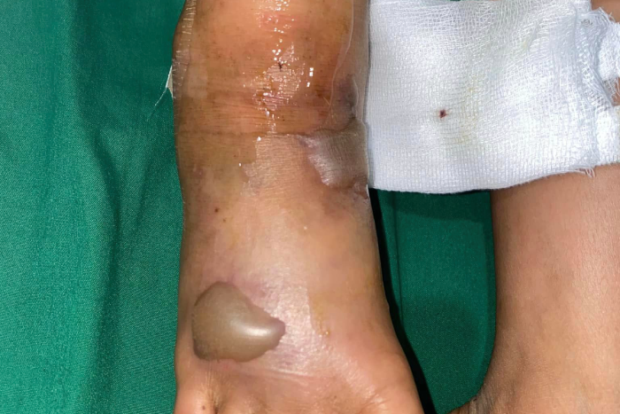 Bé trai bất ngờ bị rắn độc cắn khi đang đi bộ trong xóm