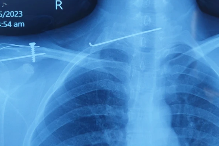 Người trẻ mắc hội chứng cổ rùa, thủ phạm từ thiết bị ai cũng sở hữu Đinh dài 8cm lạc từ xương đòn vào cột sống cổ