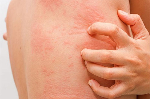 Ngứa nổi mẩn đỏ khắp người vào ban đêm mùa hè cảnh báo bệnh gì?